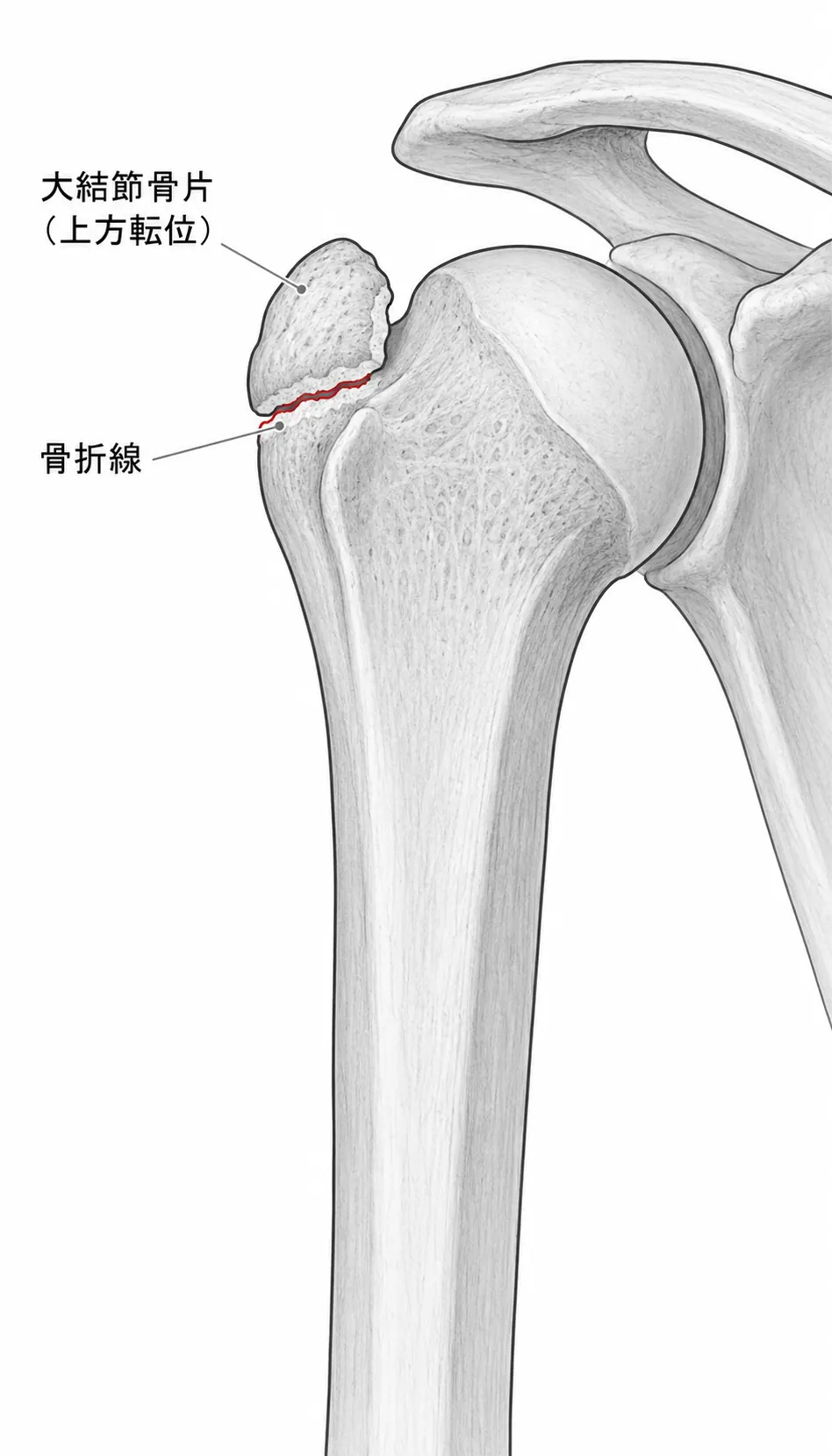 X線正面像（AP） — 大結節転位量の計測