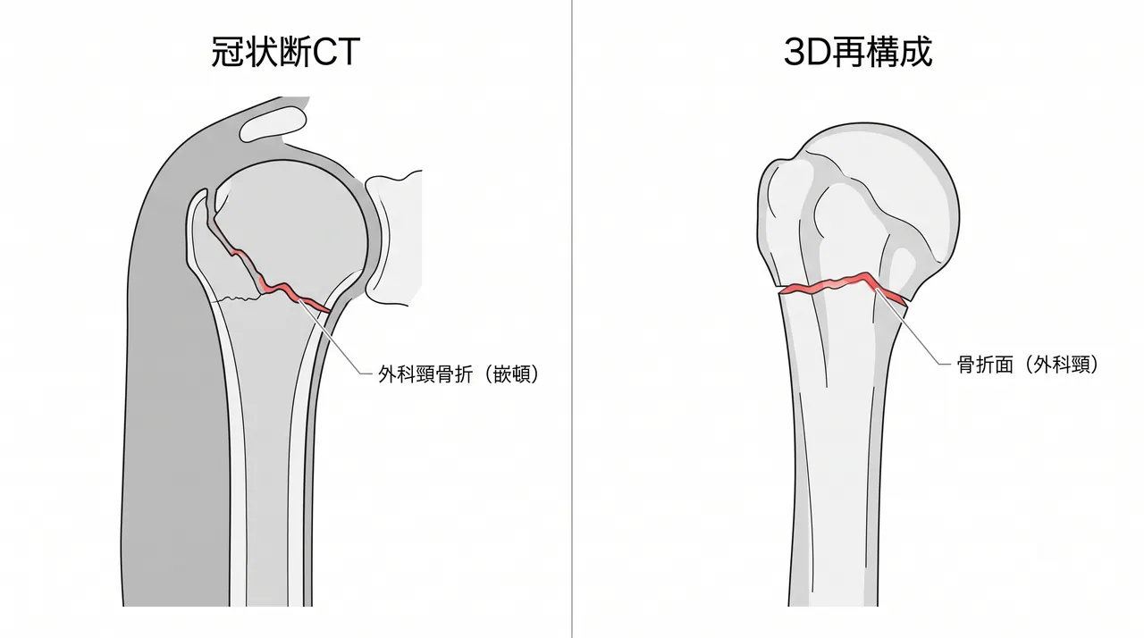 CT冠状断＋3D再構成 — 粉砕評価・大結節転位の確認