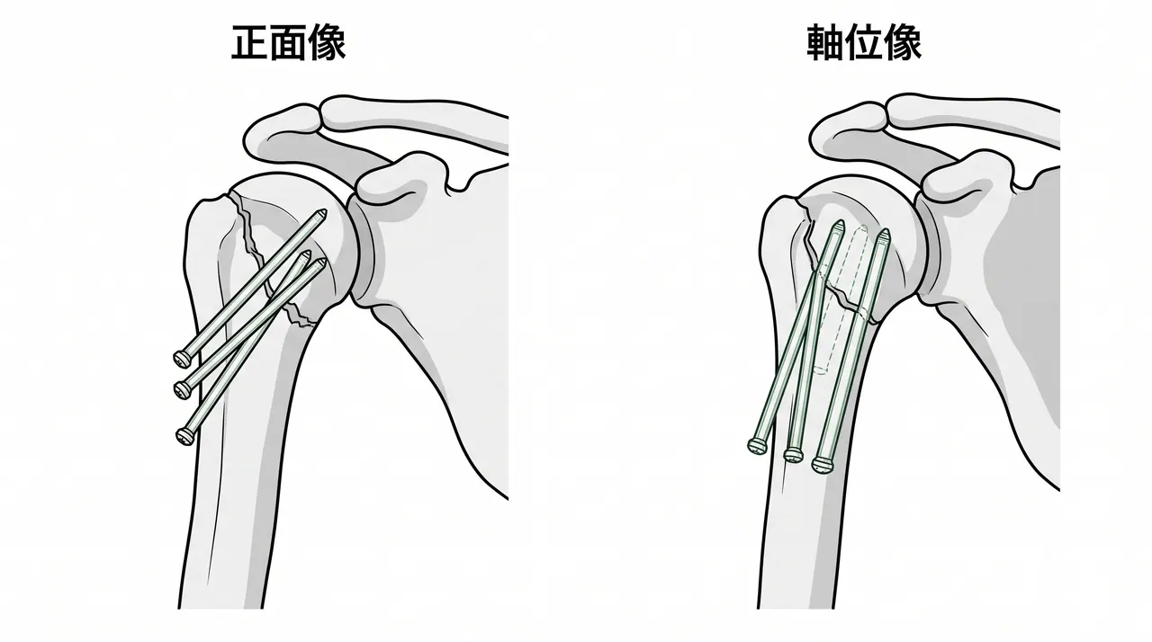 術後X線像（true AP / axillary lateral）— プレート位置・整復位確認