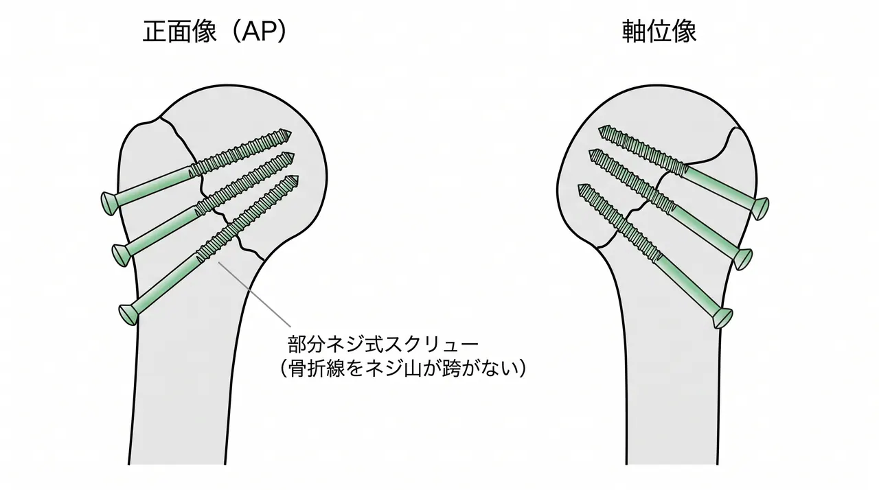スクリュー配置概念図 — 2〜3本のラグスクリュー配置（AP / 軸位）