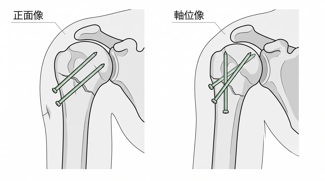 術中透視像 — スクリュー位置確認（true AP / axillary lateral）