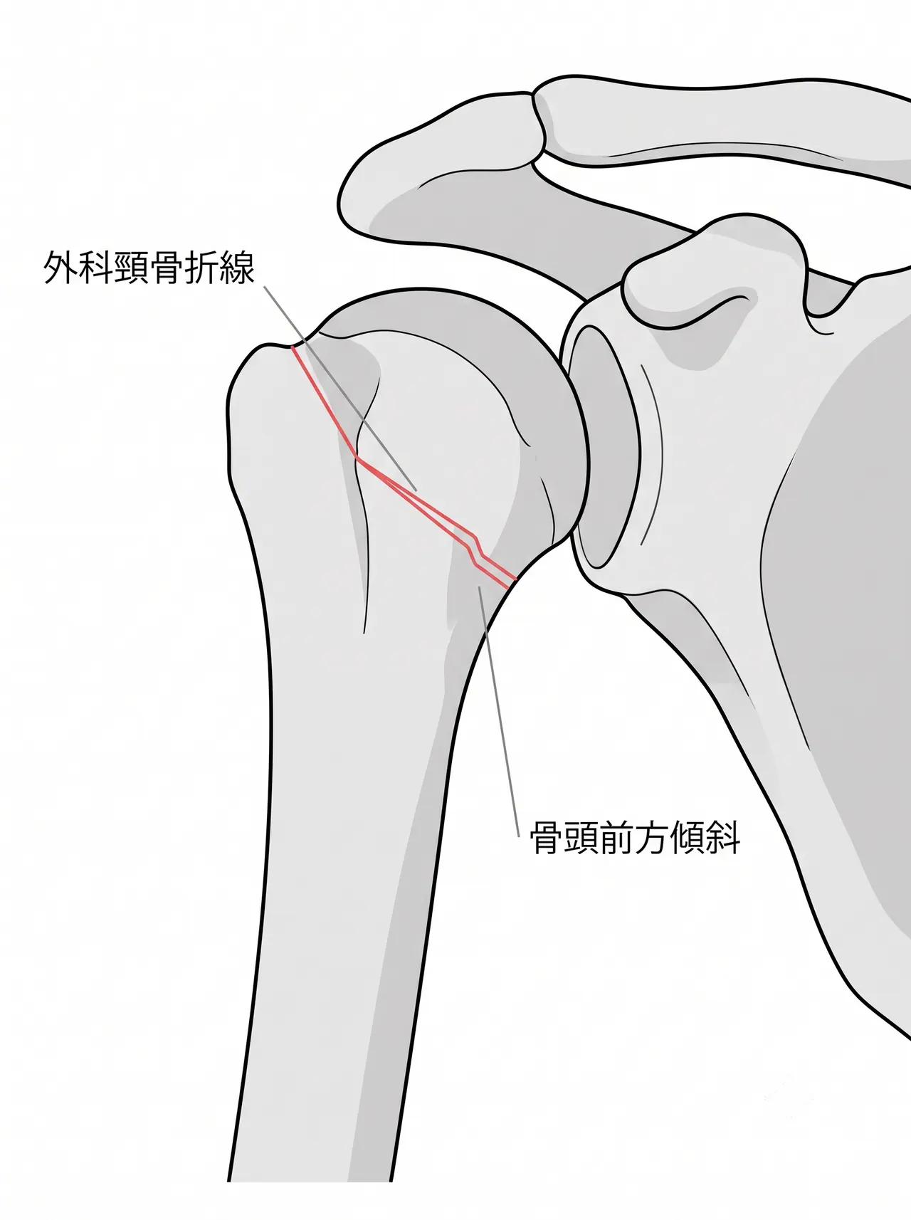X線軸位像（axillary lateral） — 骨頭傾斜・前後転位の評価