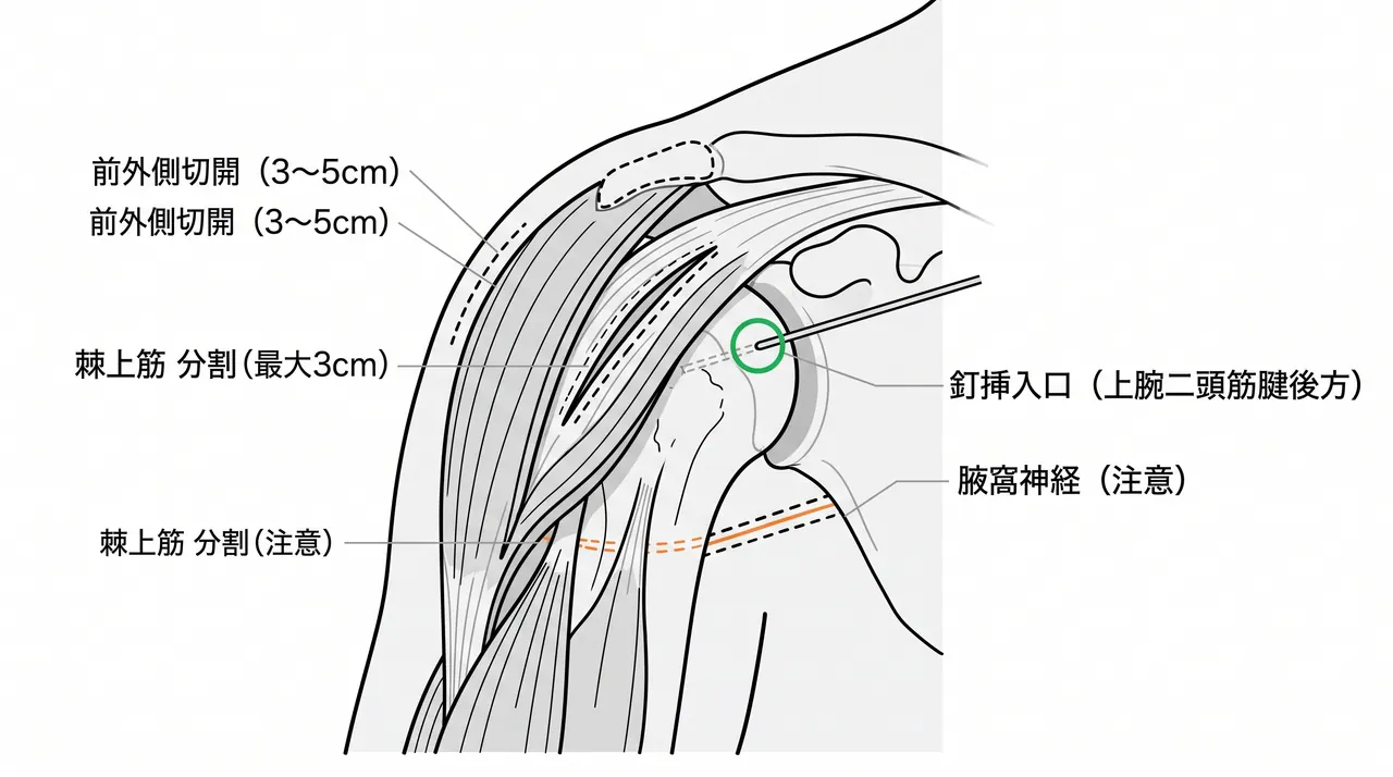 前外側アプローチ — 棘上筋分割と釘挿入口