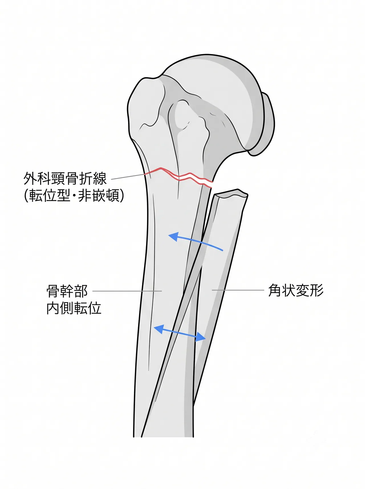 X線正面像（true AP / Grashey view）— 外科頸骨折の転位評価