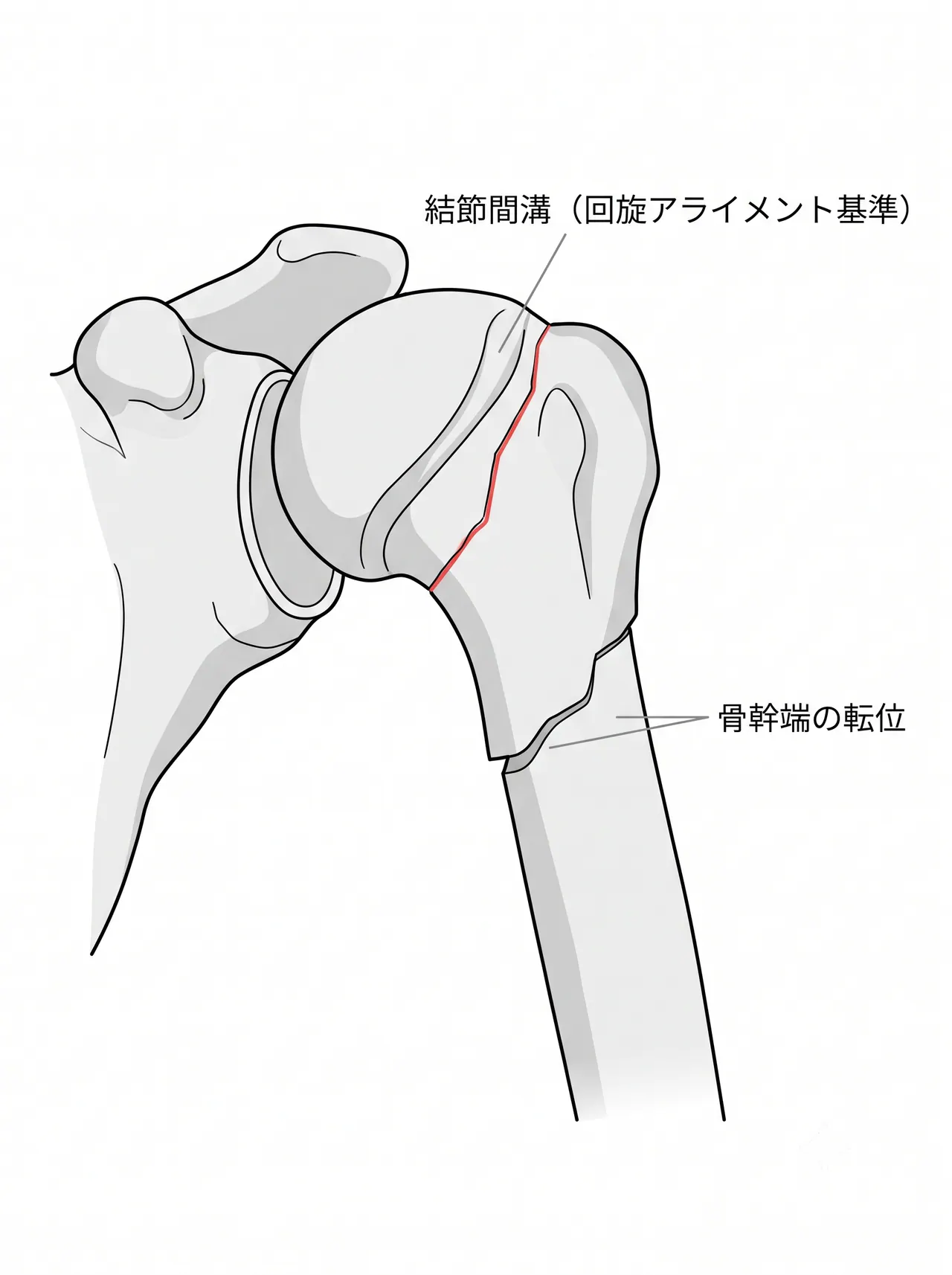 腋窩像（axillary view）— 回旋ずれ・関節内進展の評価