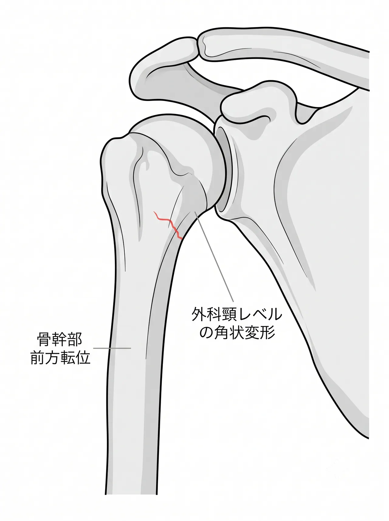 X線側面像（scapular Y view）— 前後方向の転位・角状変形評価