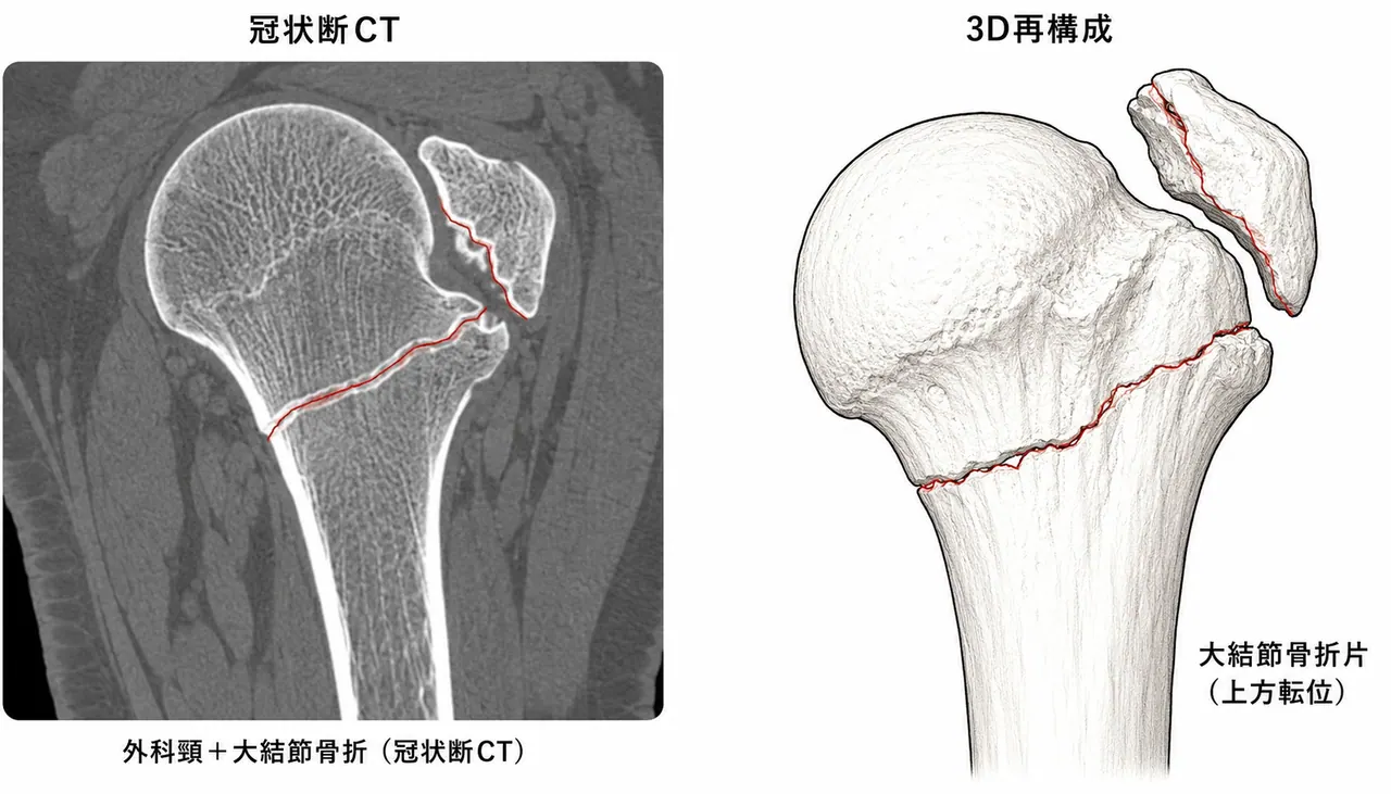 CT冠状断 + 3D再構成 — 骨折形態・大結節転位の詳細評価