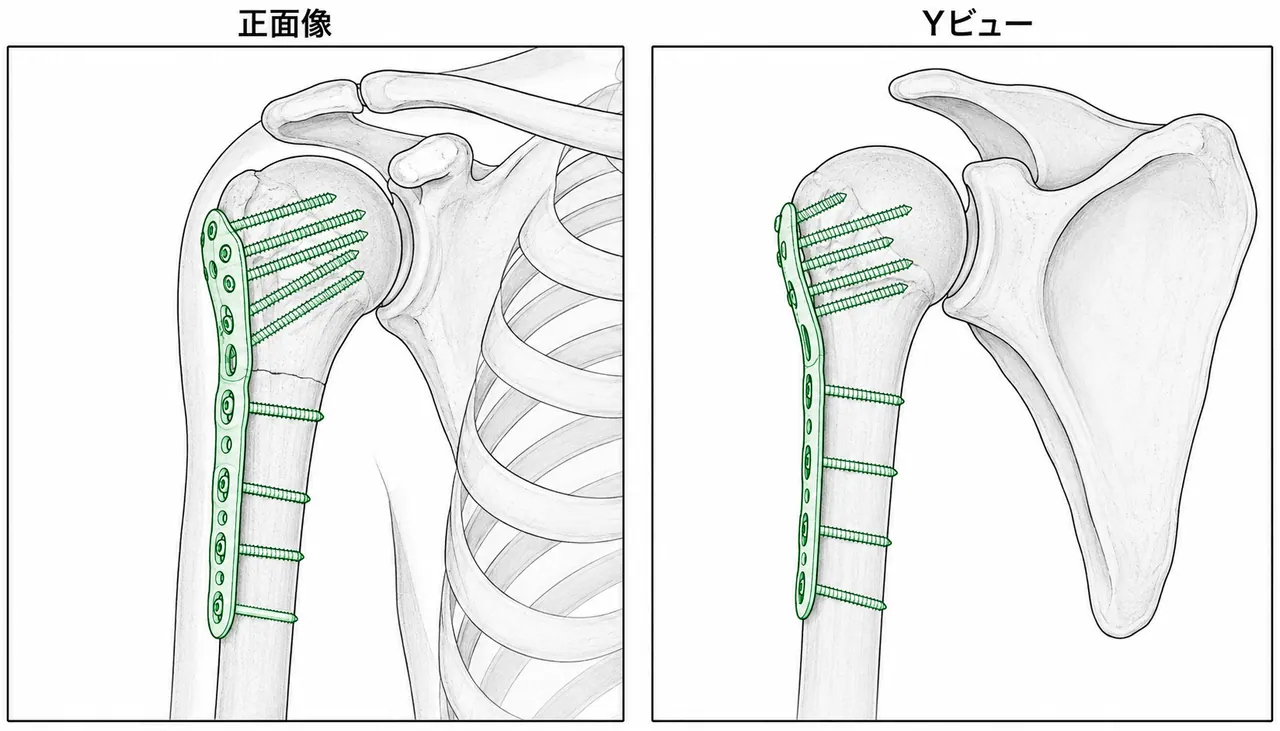 術後X線像（正面 / Y-view）— プレート位置・整復位・スクリュー配置確認