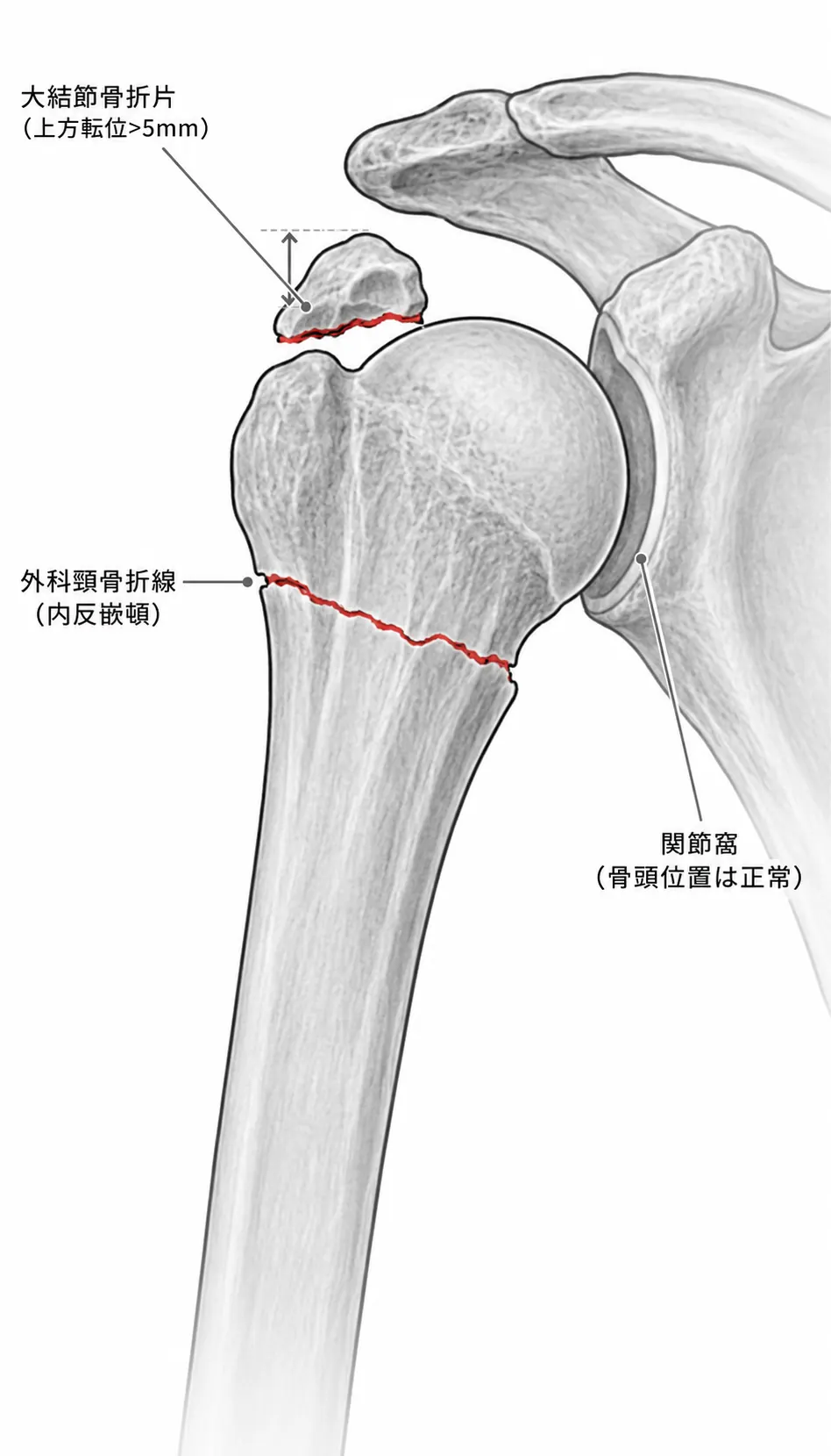 X線正面像（Grashey view）— 外科頸＋大結節骨折線の評価