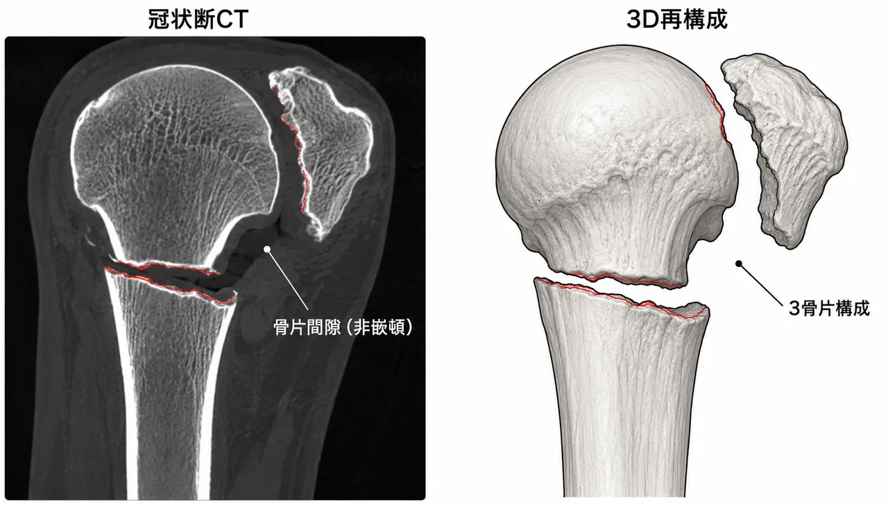 CT冠状断 + 3D再構成（骨片形態・結節位置の評価）