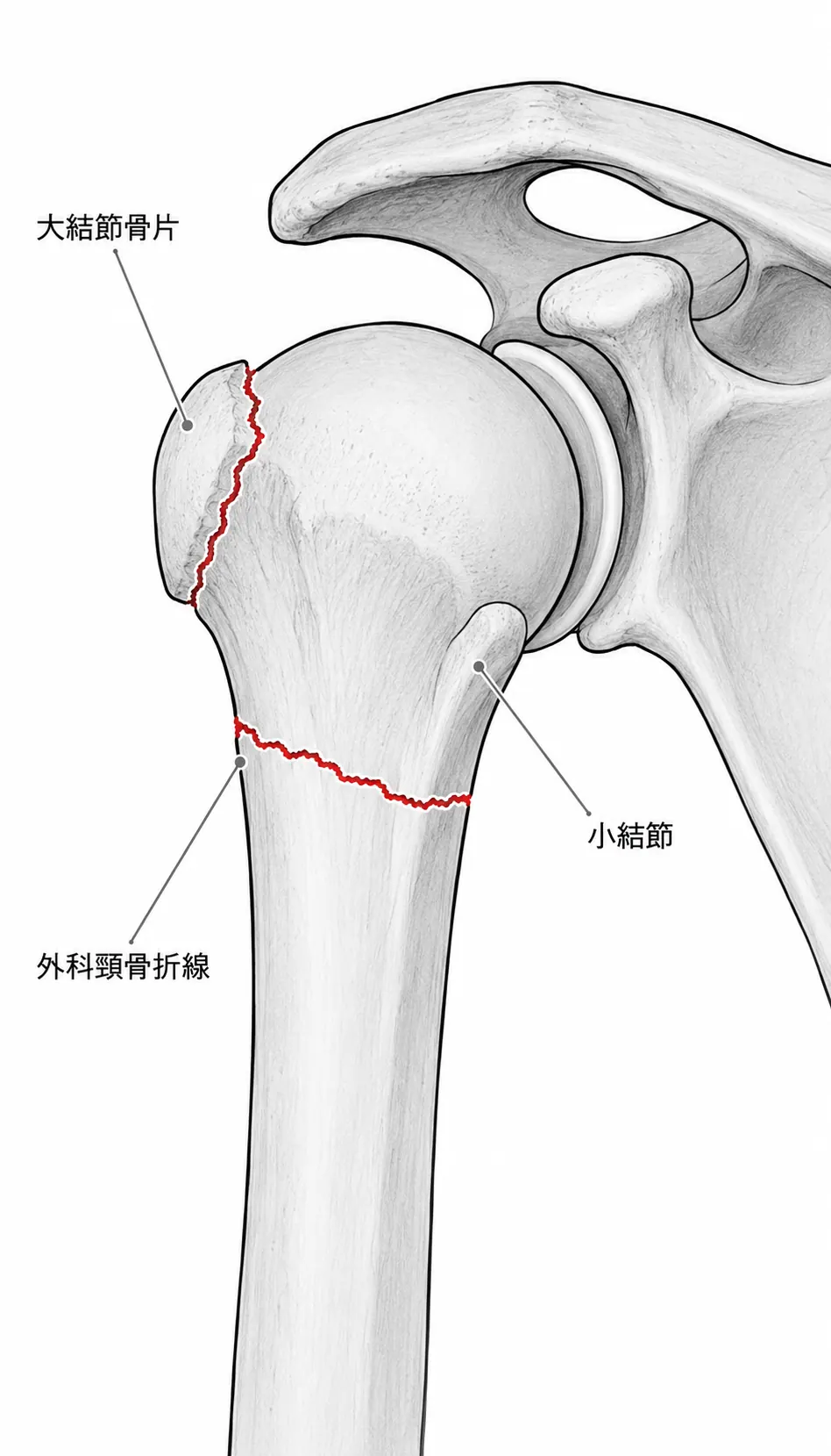 術前X線Axillary像（骨頭位置・結節転位の確認）