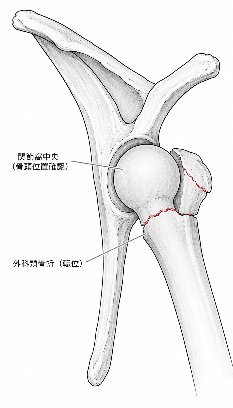 術前X線Scapular Y像（外科頸転位の方向と程度）