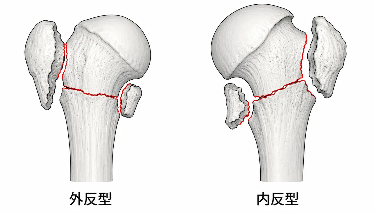 CT三次元再構成 — 4パート骨折パターン（外反型・内反型）の確認