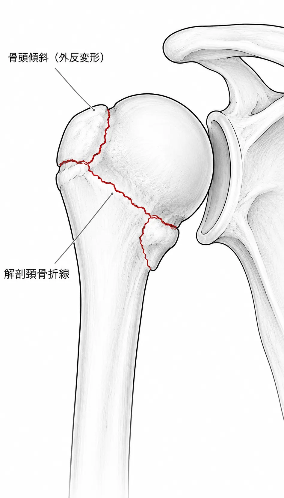 腋窩像（Axillary lateral）— 骨頭傾斜・結節転位の評価