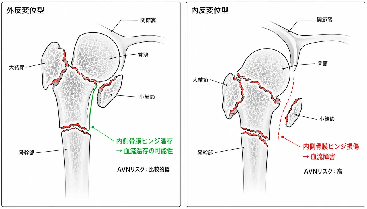AO分類11-C2 骨折型模式図 — 外反型・内反型の比較