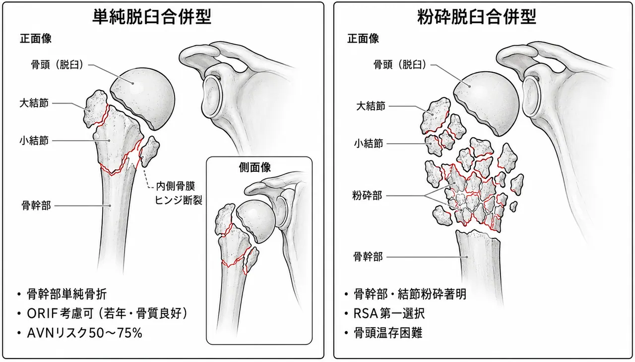 11-C3分類模式図 — 前方脱臼合併型（単純・粉砕型）の骨片配置比較