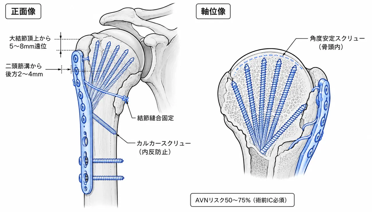ロッキングプレート設置概念図（AP / 軸位）