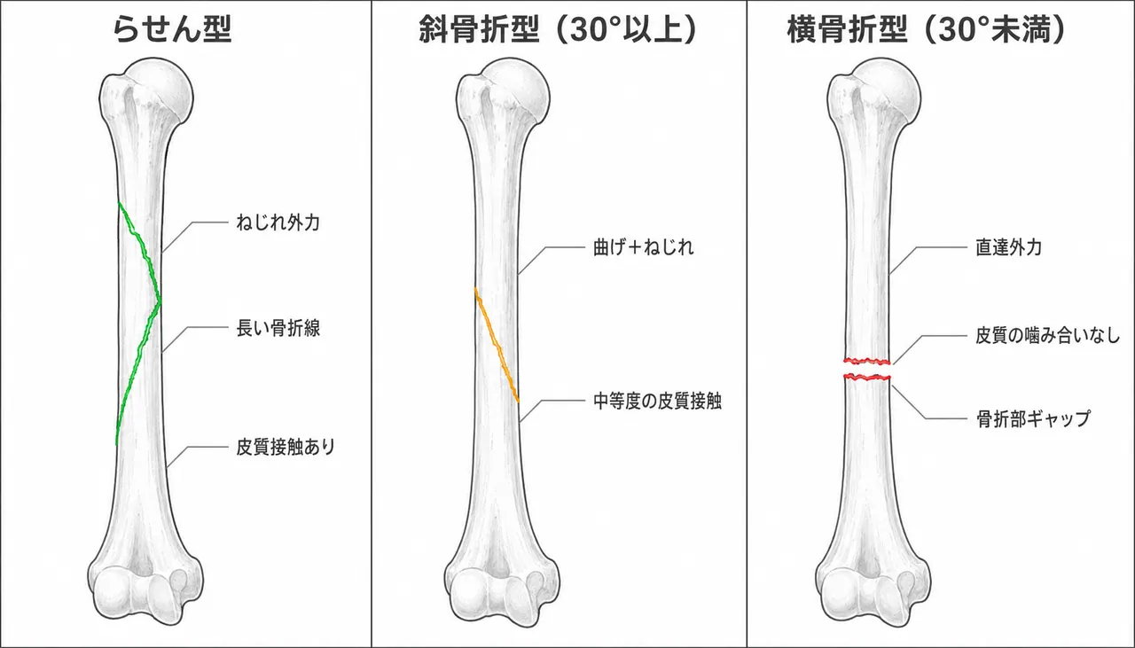 骨折パターン比較 — 12-A1（螺旋）vs 12-A2（斜骨折 ≥30°）vs 12-A3（横骨折）
