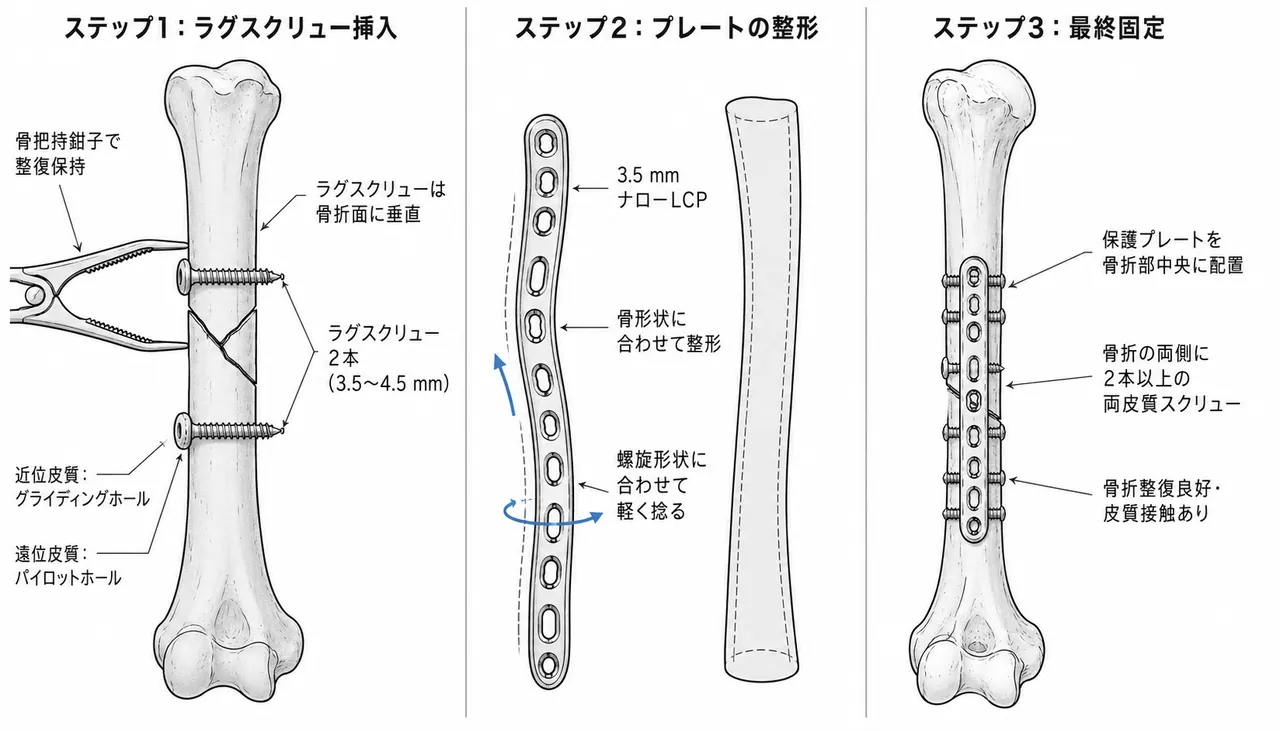 ラグスクリュー留置とプレート固定の手順