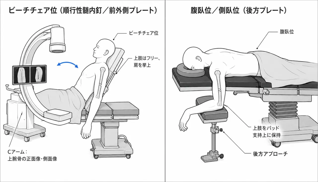 手術体位 — ビーチチェアポジション（順行性釘）またはラテラル/腹臥位（後方プレート）