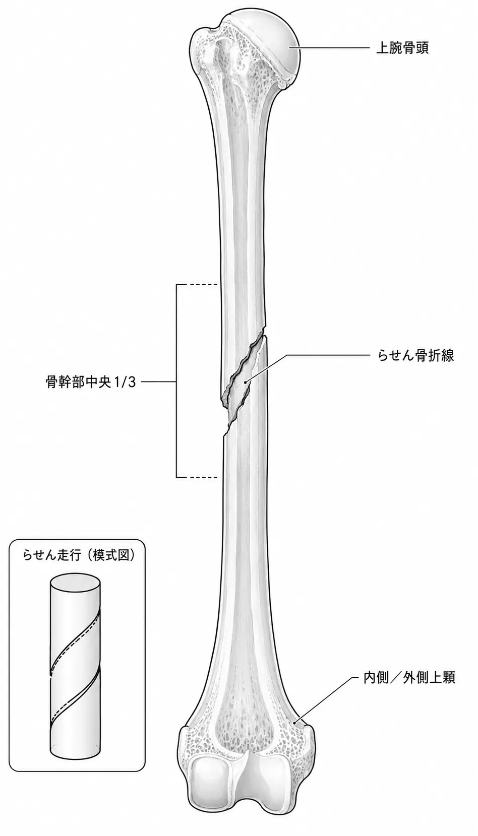 X線正面像 — 上腕骨骨幹部螺旋骨折パターン（中央1/3）