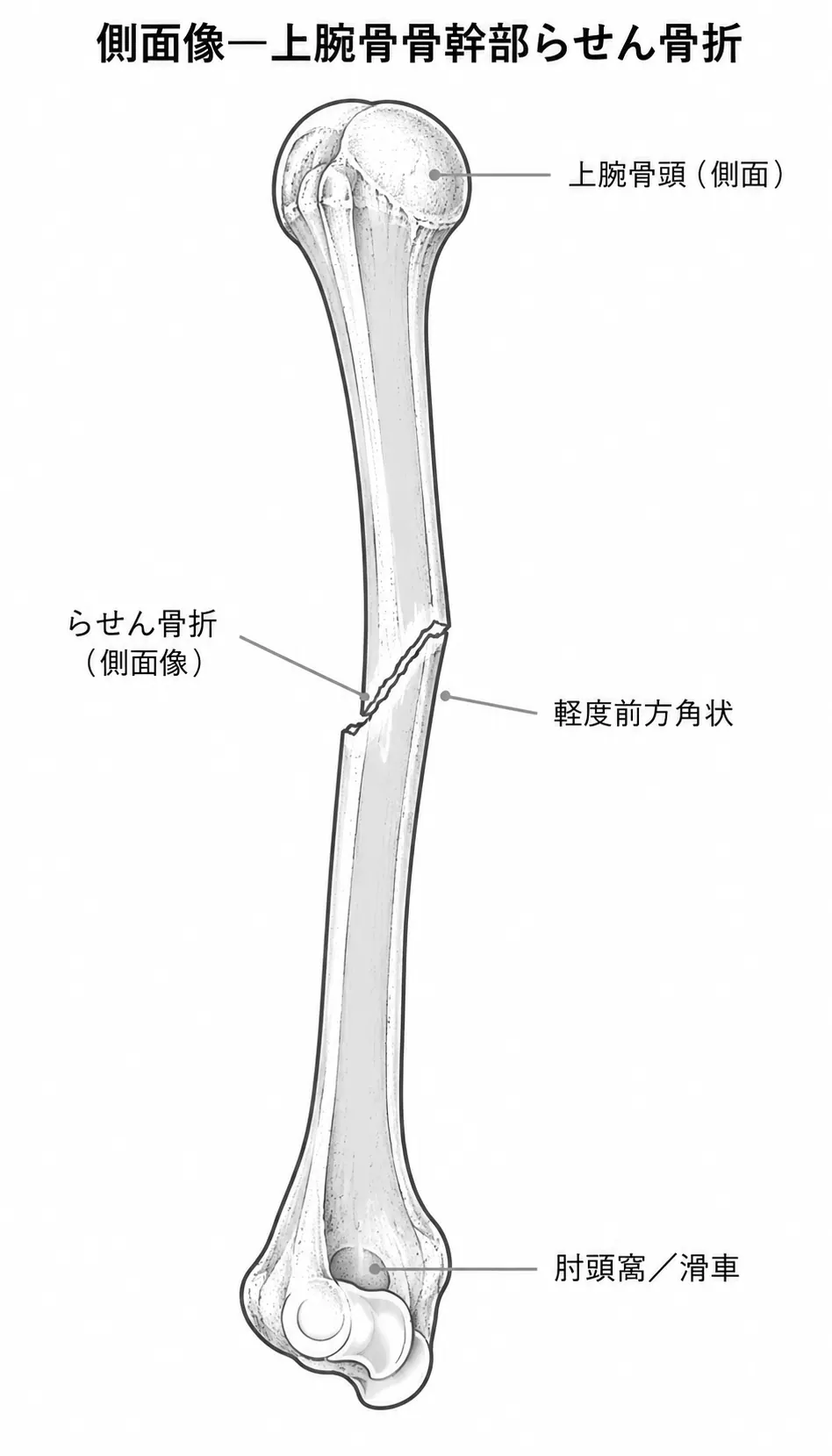 X線側面像 — 骨折線の方向と変位の程度