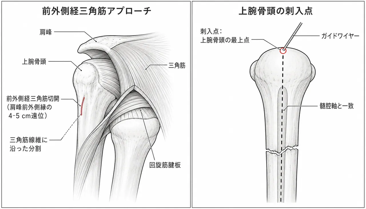 エントリーポイント（上腕骨頭最高点）— 前外側経三角筋アプローチ