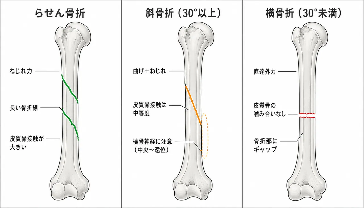 骨折パターン比較 — 12-A1（螺旋）vs 12-A2（斜骨折≥30°）vs 12-A3（横骨折<30°）