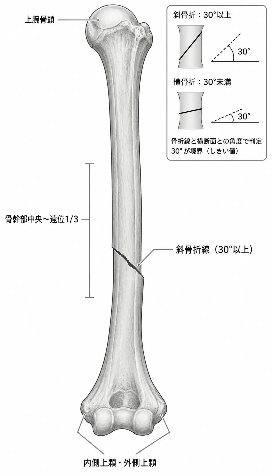 X線正面像 — 上腕骨骨幹部斜骨折（中央〜遠位1/3）骨折線傾斜≥30°