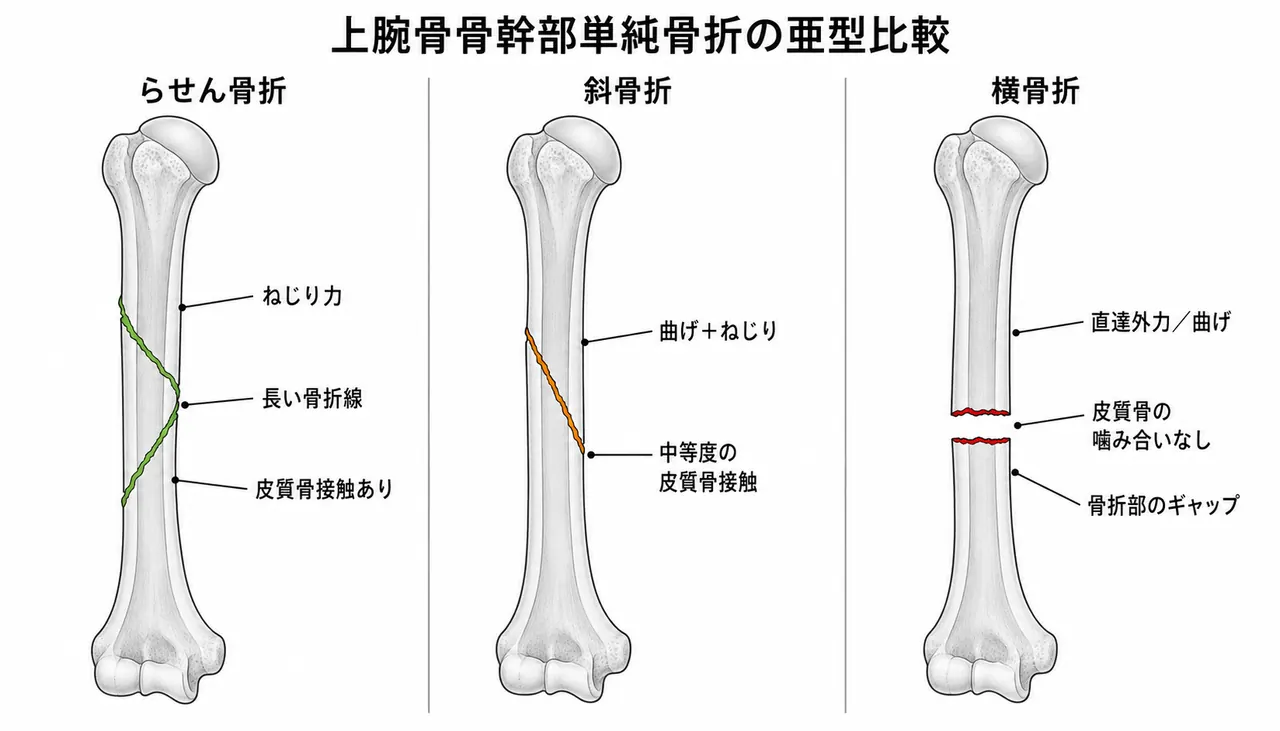 骨折パターン比較 — 12-A1（螺旋）vs 12-A2（斜骨折）vs 12-A3（横骨折）
