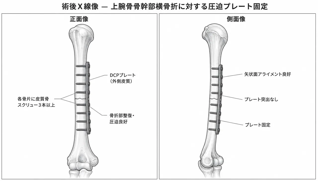 術後X線像（正面/側面）— 上腕骨骨幹部横骨折 ORIF プレート固定後