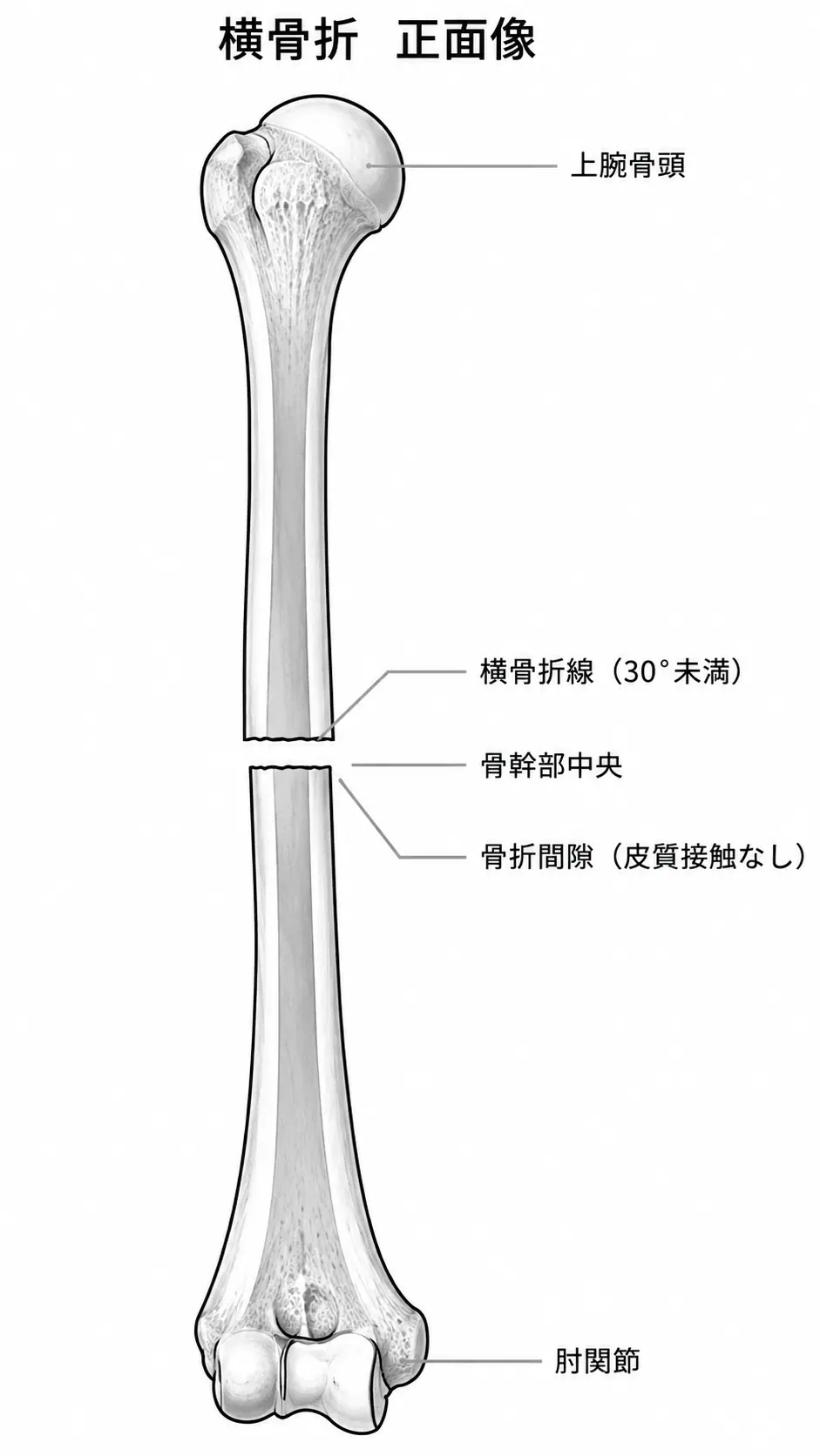X線正面像 — 上腕骨骨幹部横骨折パターン（中央1/3、骨折間隙あり）