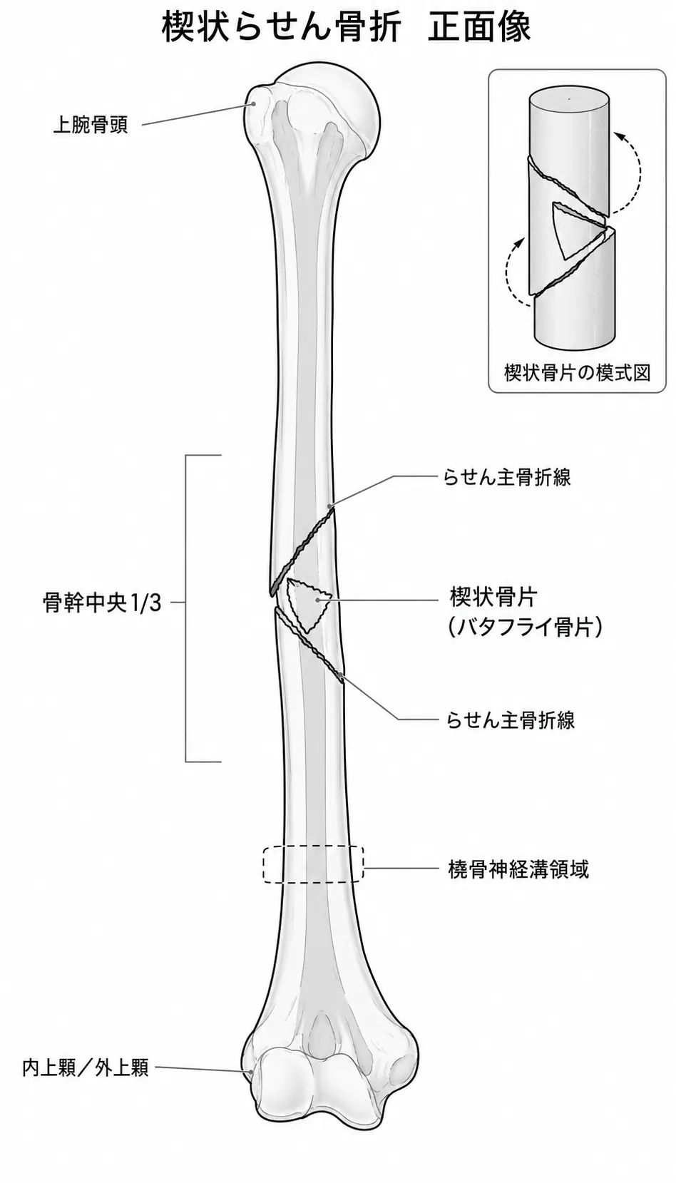 X線正面像 — 上腕骨骨幹部楔状螺旋骨折パターン（12-B1）