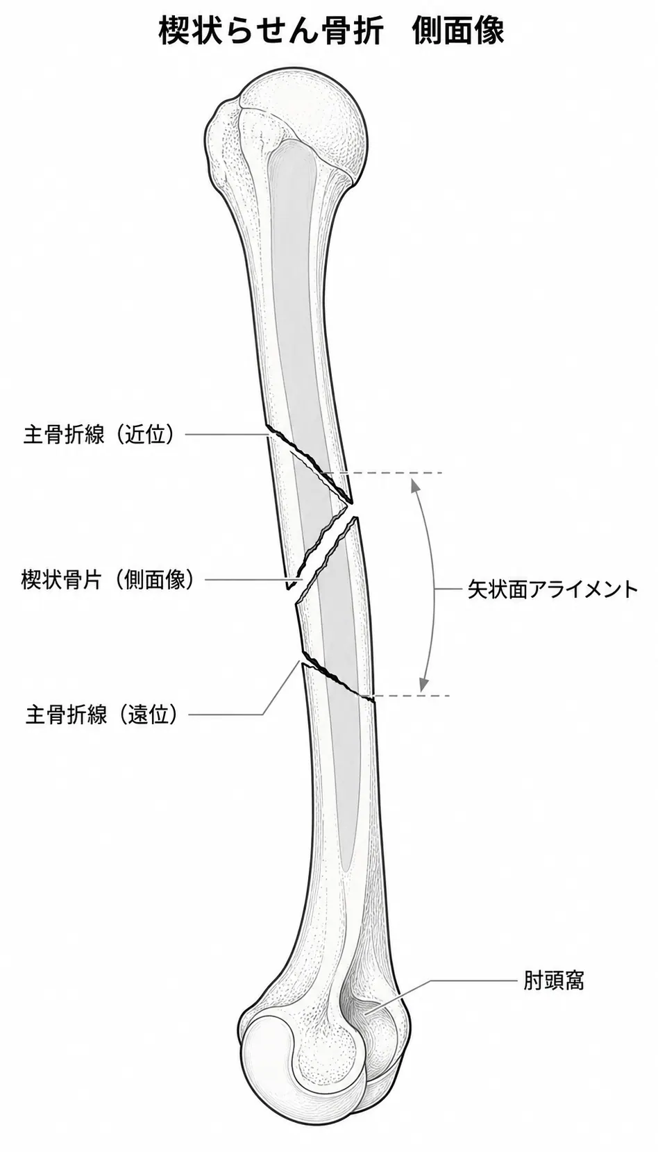 X線側面像 — 楔状骨片の形態・骨折部の転位確認