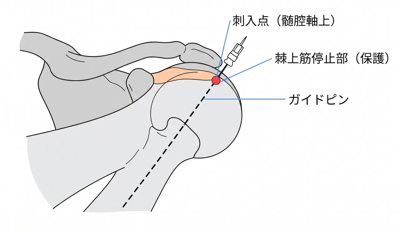 エントリーポイント — 上腕骨頭最高点（髄腔軸上・棘上筋停止部より後内側）