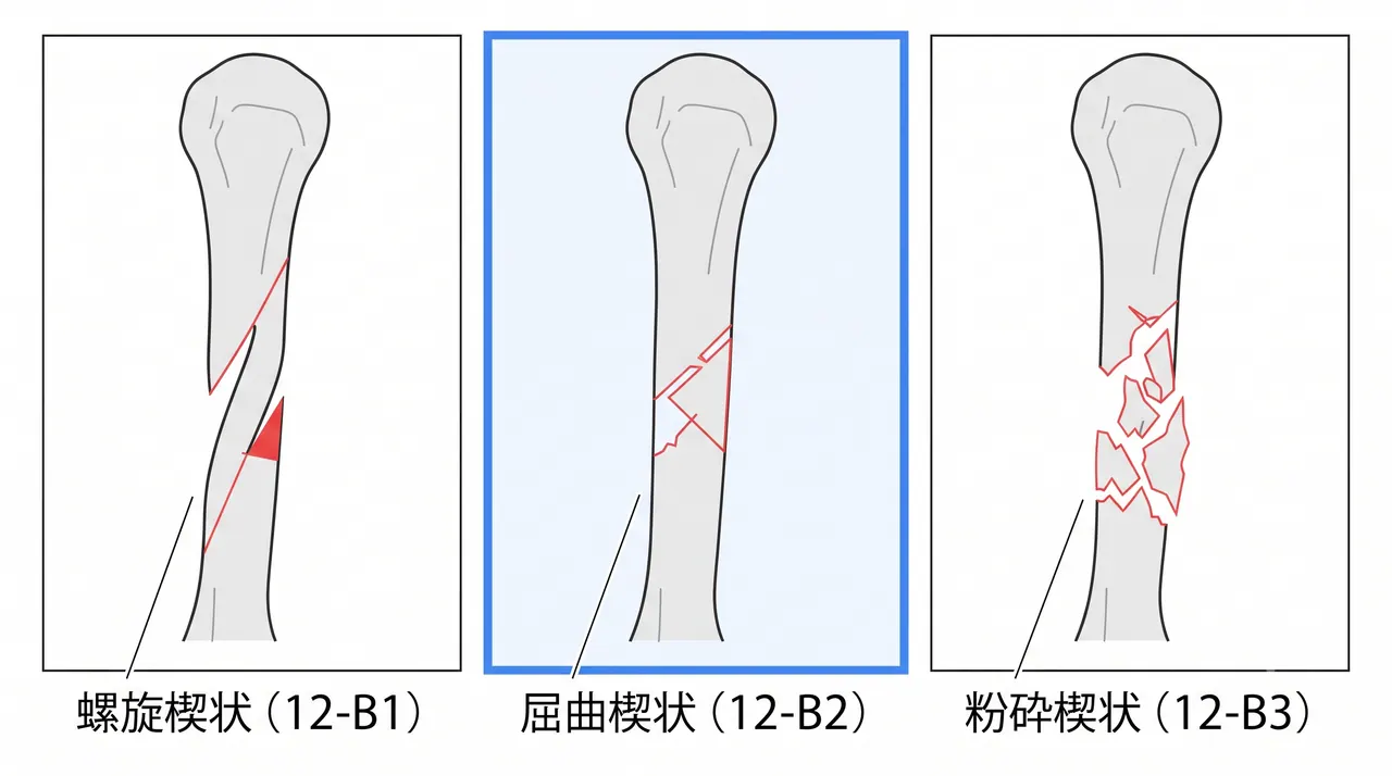骨折パターン比較 — 12-B1（螺旋楔状）vs 12-B2（屈曲楔状）vs 12-B3（粉砕楔状）
