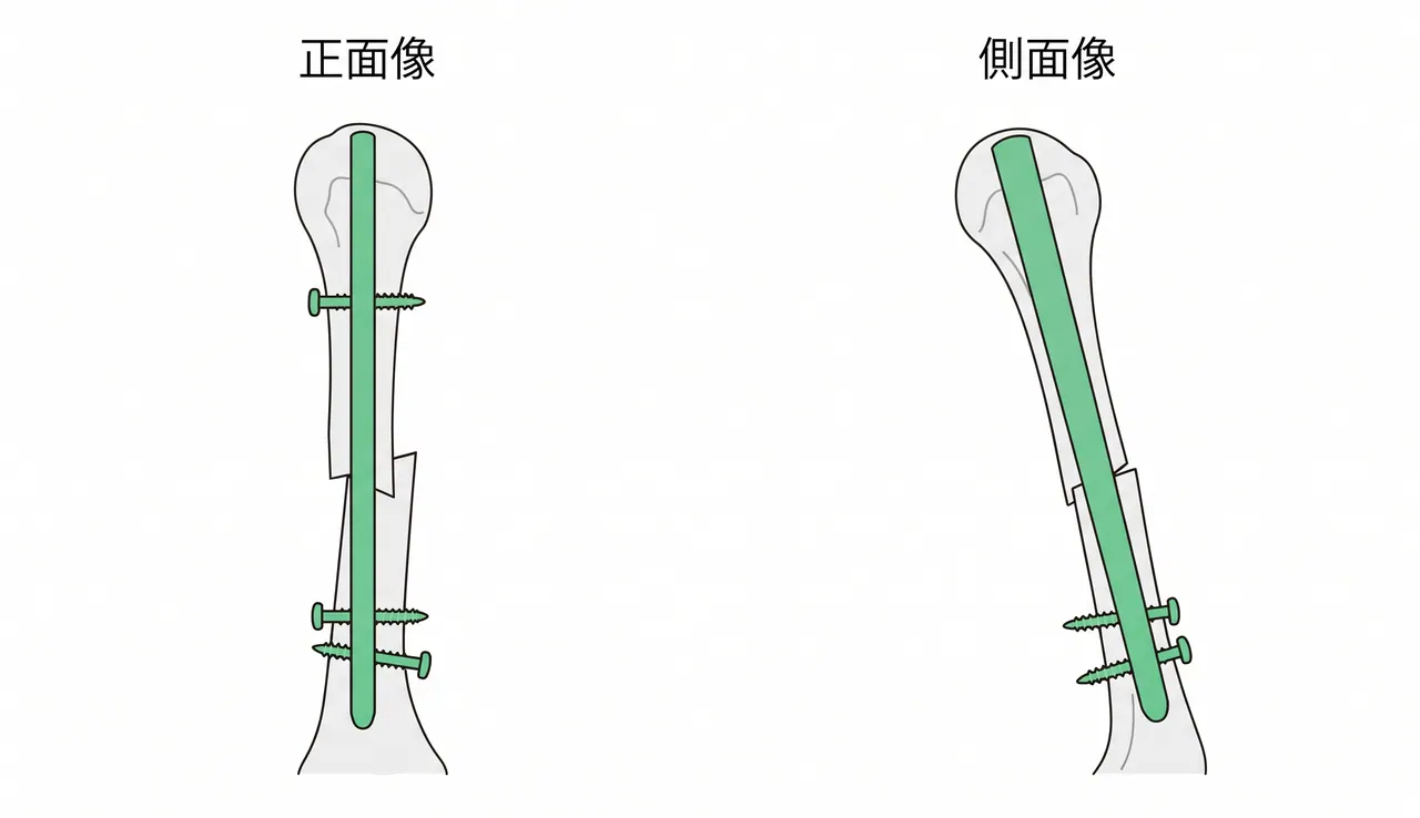 術後X線像（正面/側面）— 順行性髄内釘またはプレート固定後