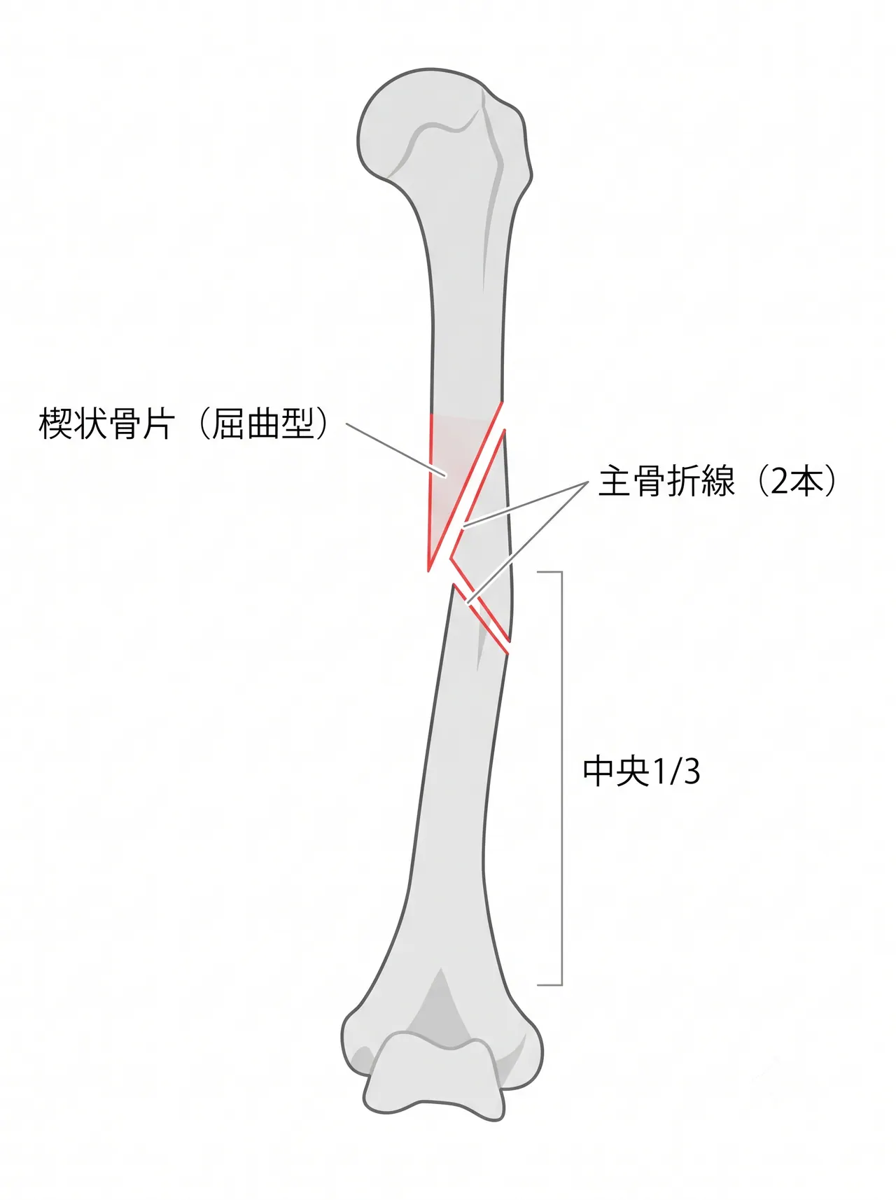 X線正面像 — 上腕骨骨幹部楔状骨折（中央1/3・屈曲型楔状骨片）