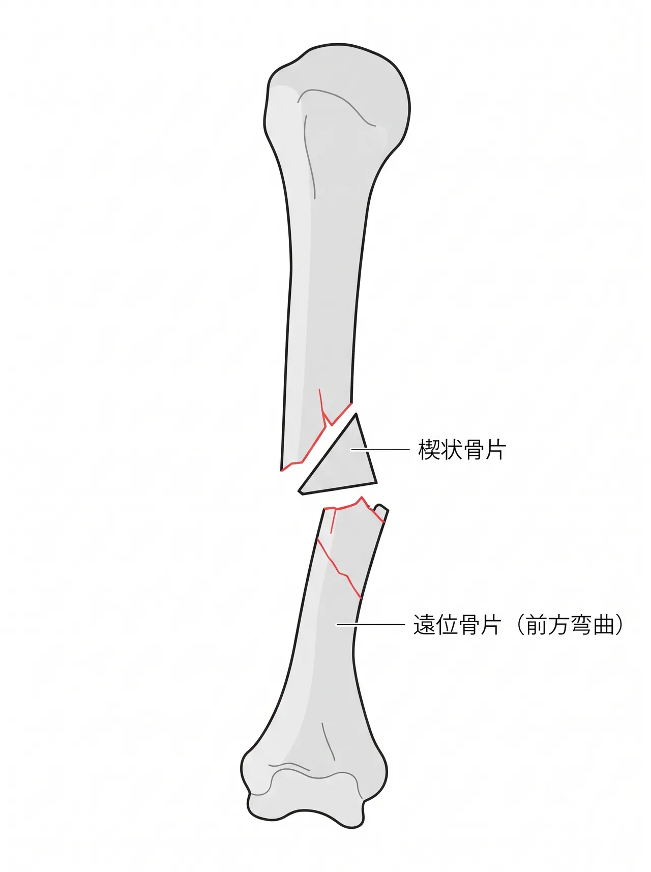 X線側面像 — 骨折転位の方向・楔状骨片の位置確認