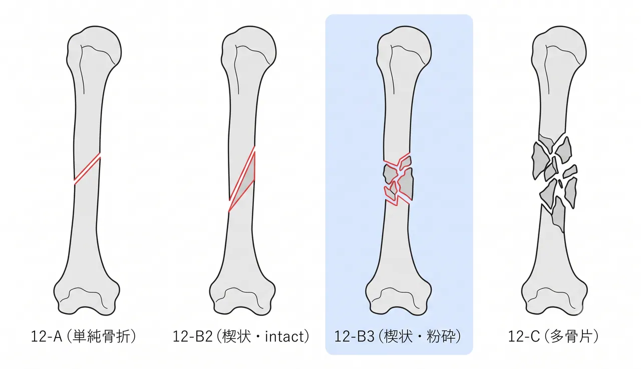 AO分類比較図 — 12-A（単純）vs 12-B2（intact wedge）vs 12-B3（fragmentary wedge）vs 12-C（多骨片）