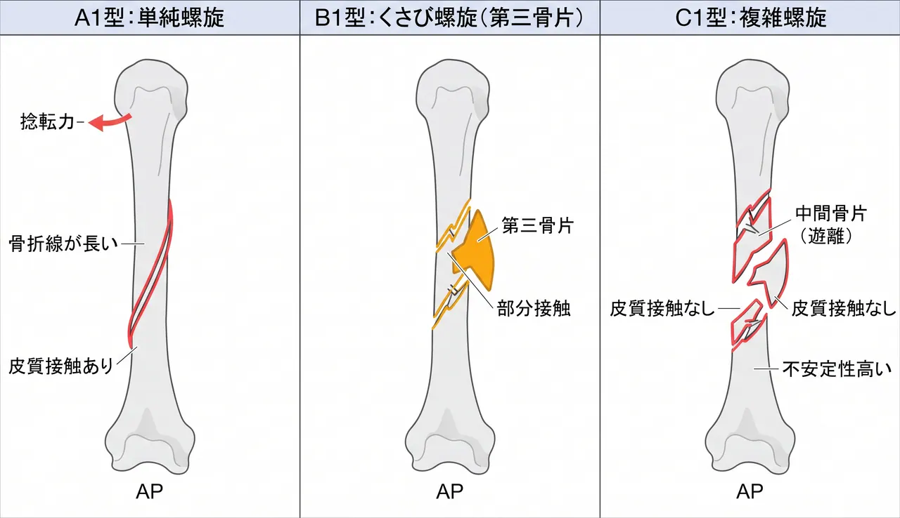 骨折パターン比較 — 12-A1（単純螺旋）vs 12-B1（くさび螺旋）vs 12-C1（複雑螺旋）
