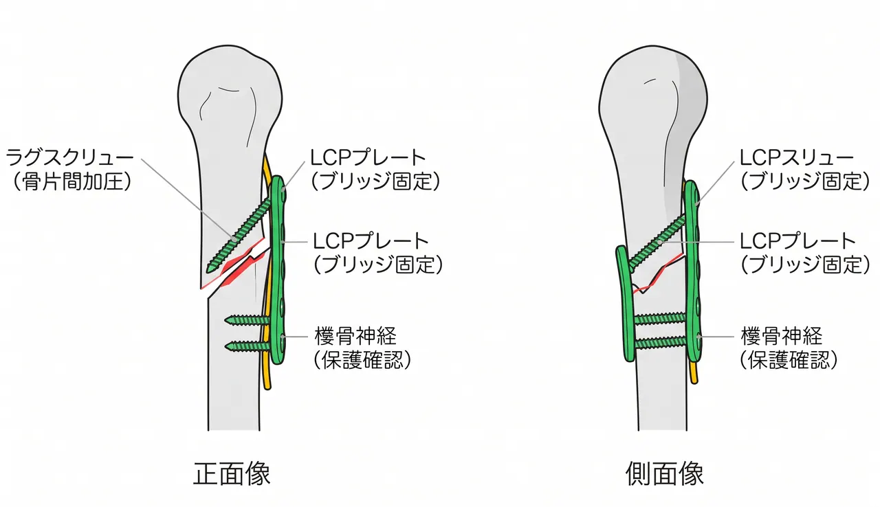 ラグスクリュー＋LCPプレート配置 — 中間骨片の圧迫固定と橈骨神経の保護
