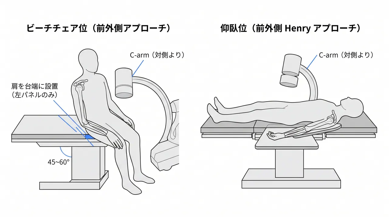 手術体位 — ビーチチェア位（半座位）または側臥位での後方アプローチ