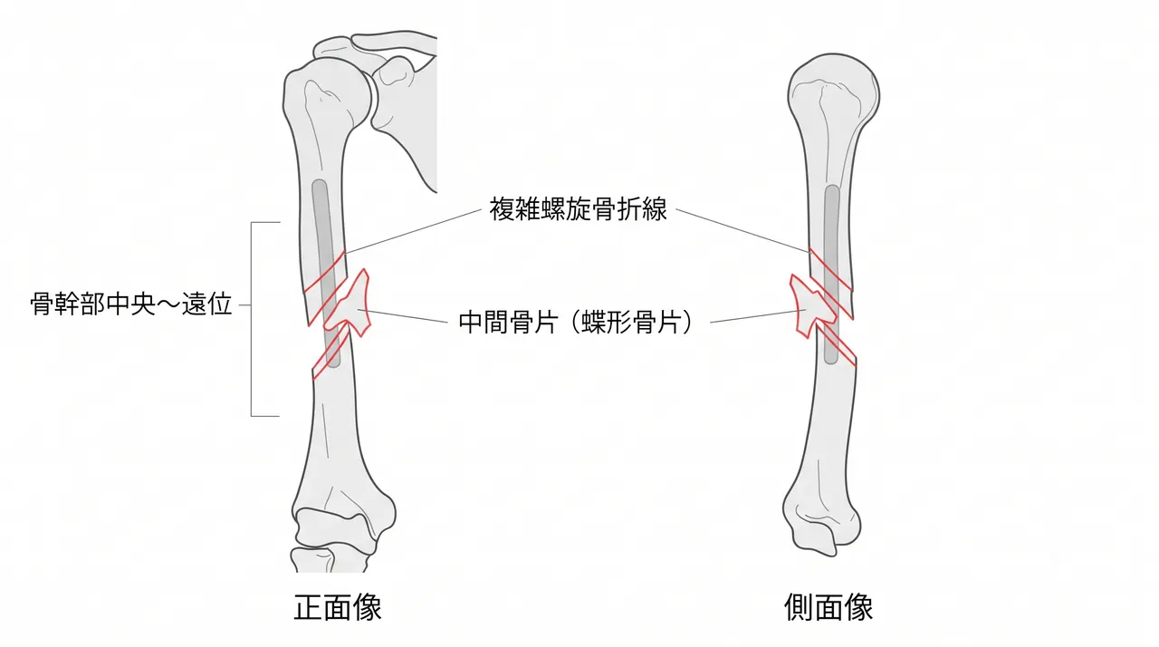 X線正面像・側面像 — 上腕骨骨幹部複雑螺旋骨折（中間骨片あり）