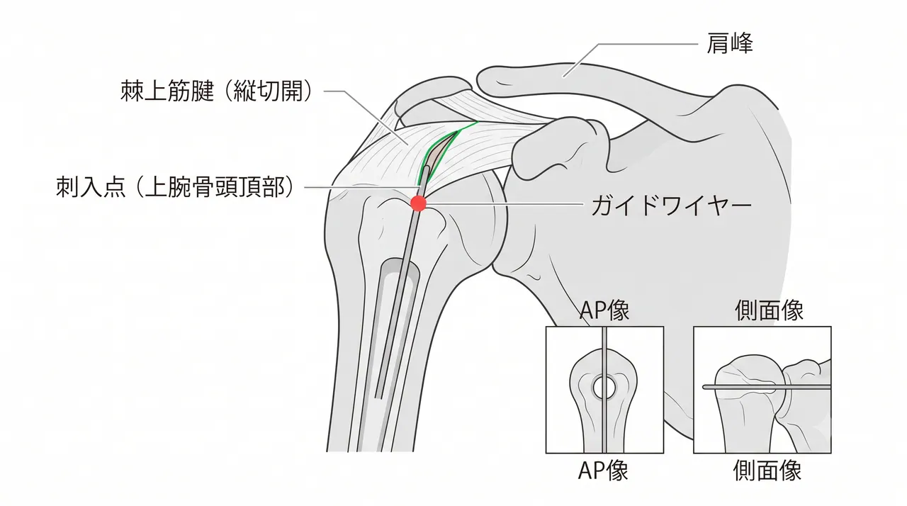 エントリーポイント — 上腕骨頭頂部（肩峰後内側）のガイドワイヤー刺入