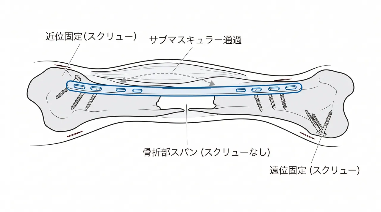 ブリッジプレート設置概念図 — 長プレートのサブマスキュラー通過と近位・遠位固定
