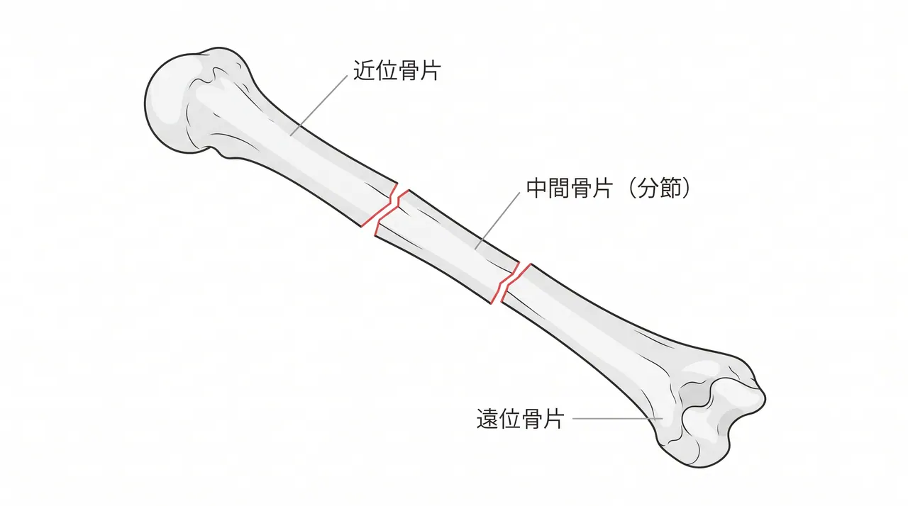 CT 3D再構成 — 分節骨折の全体像・中間骨片評価・骨折線方向の確認