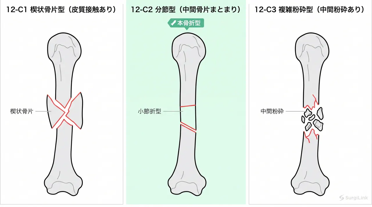 AO分類 12-C2 骨折型模式図 — 複雑分節型（中間骨片が比較的まとまった形態）