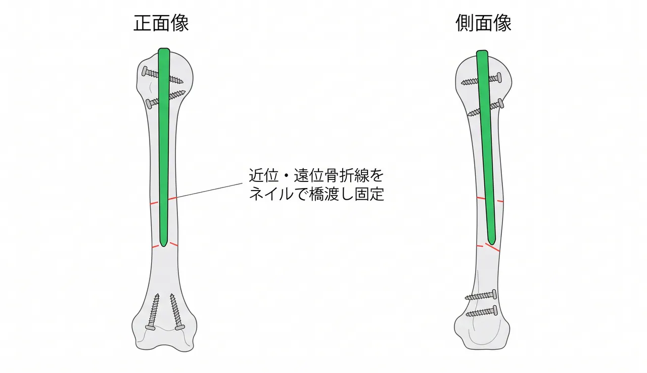 透視像 — 分節骨折へのネイル通過（ガイドワイヤー・ネイル・ロッキングスクリュー確認）