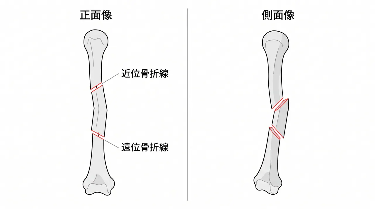 術前X線（正面/側面）— 上腕骨骨幹部分節型骨折（2か所の骨折線・中間骨片）
